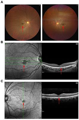 Acute macular neuroretinopathy and COVID-19 or SARS-CoV-2 infection: case report and literature review